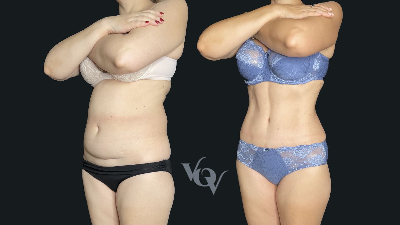 Абдоминопластика. 4 месяца после операции