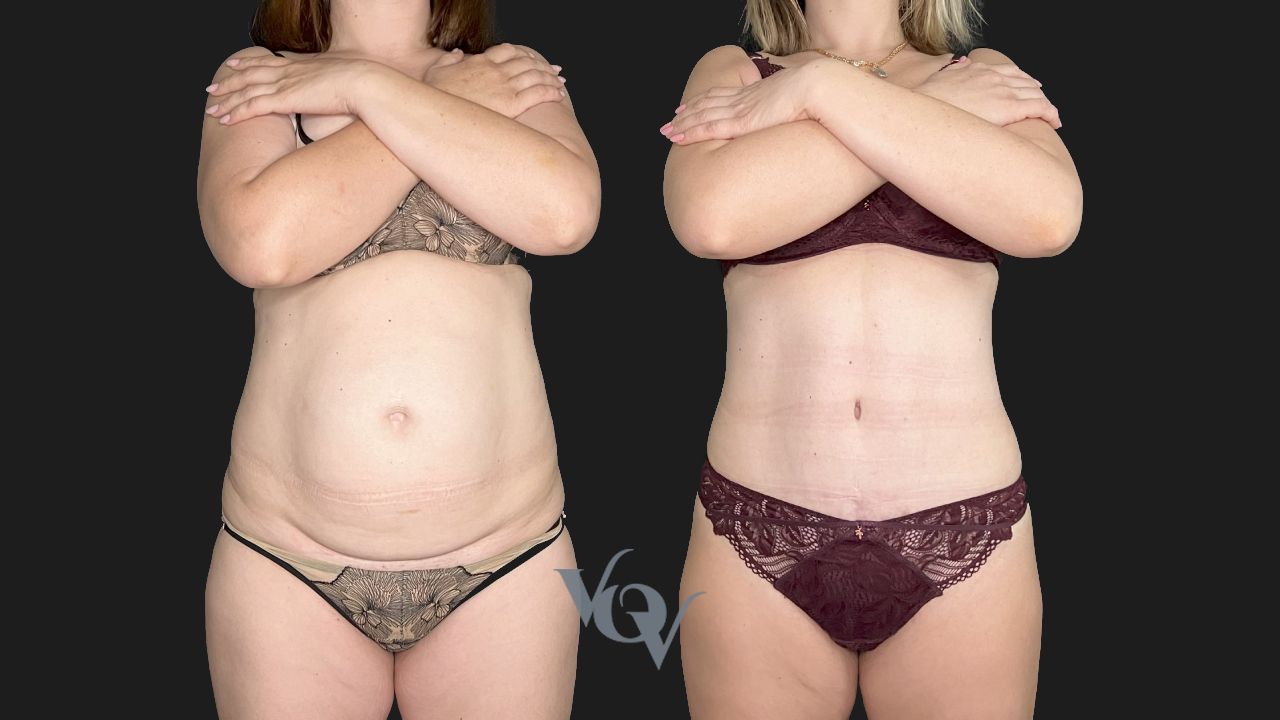 Абдоминопластика. 4 месяца после операции