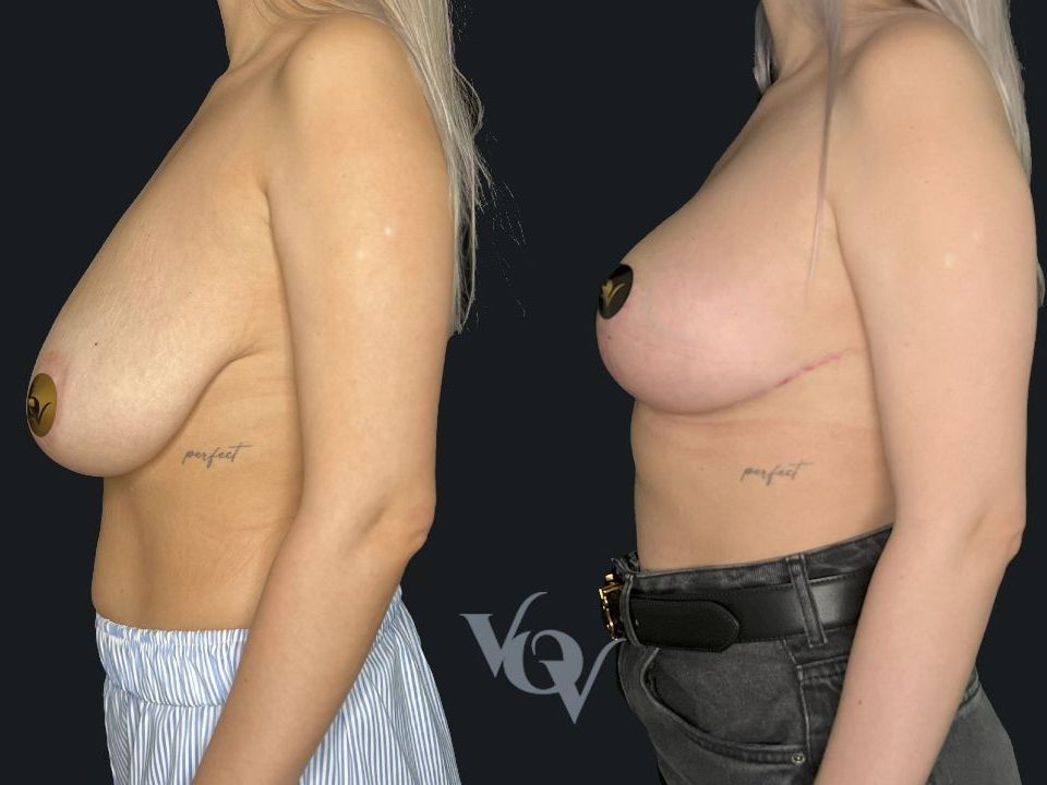 Якорная подтяжка груди. 2 месяца после операции