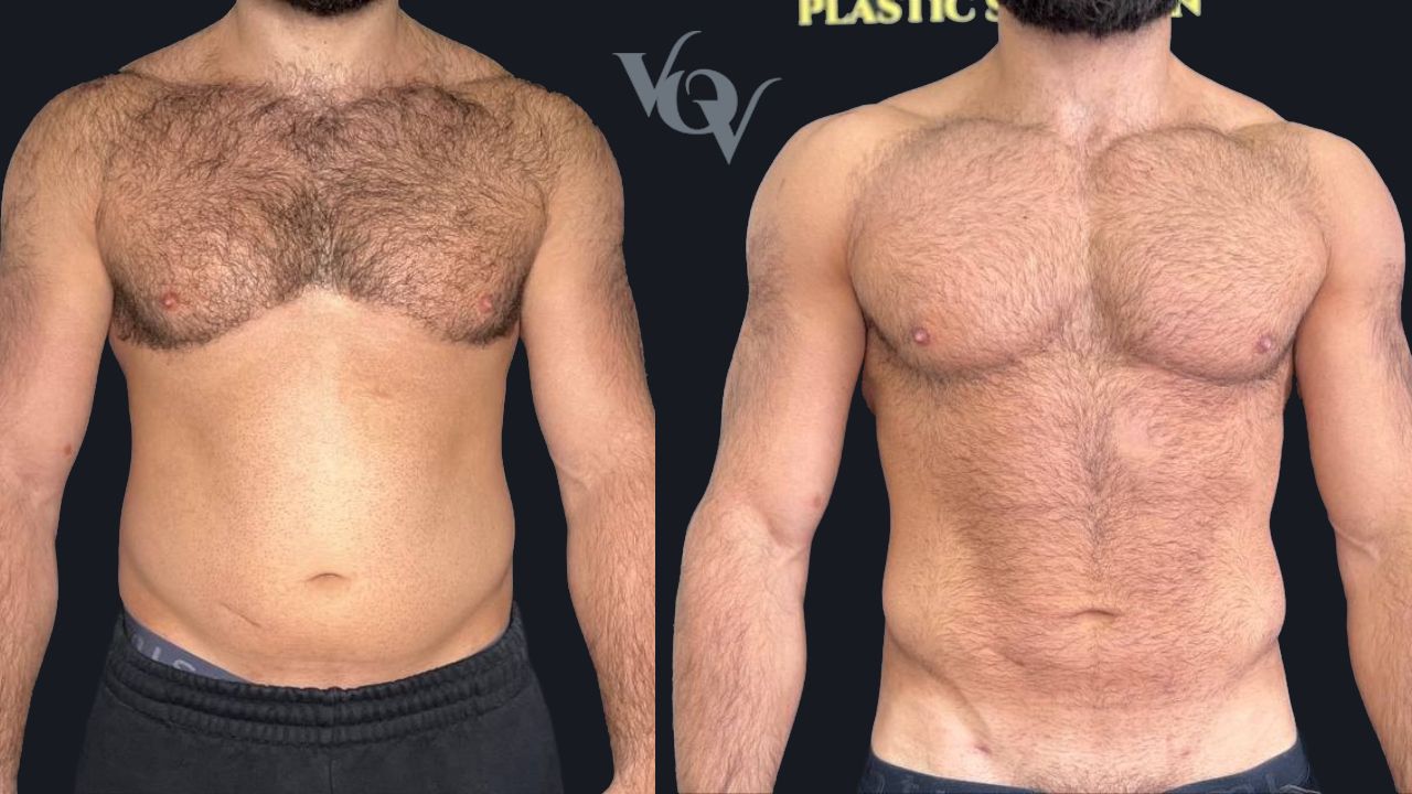 Абдоминопластика. 1 месяц после операции