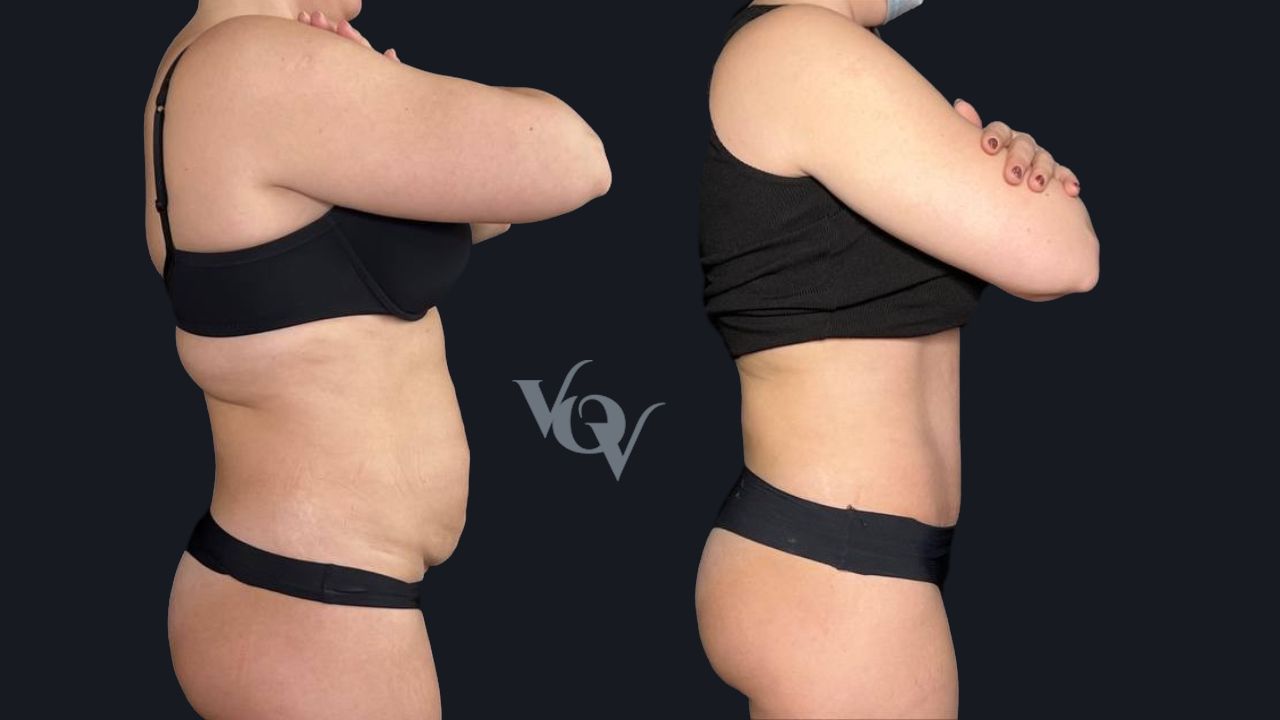 Абдоминопластика. 4 месяца после операции