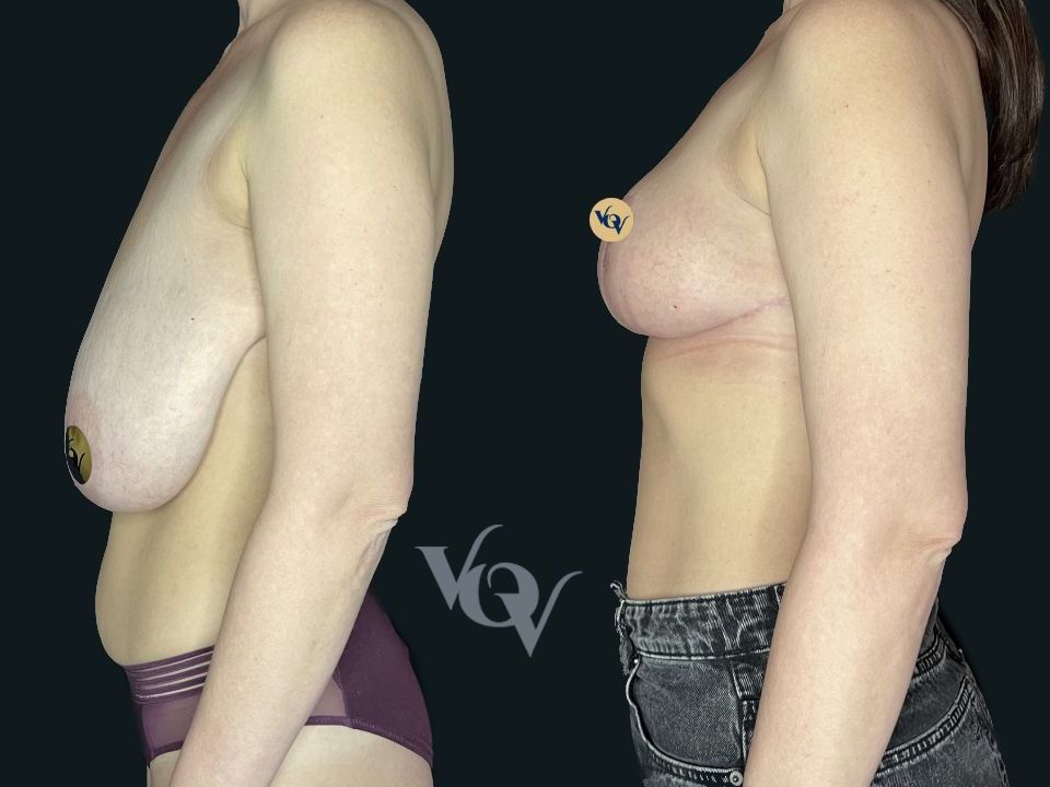 Уменьшение груди. 2 месяца после операции