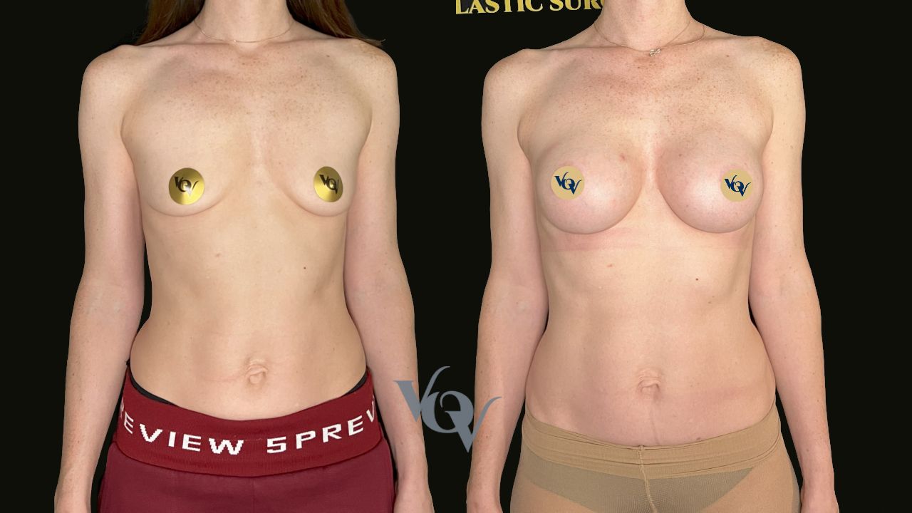 Замена имплантов. 2,5 месяца после операции