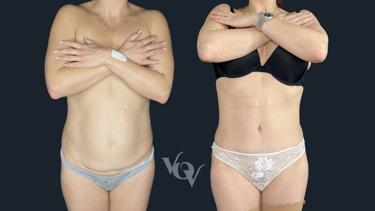 Абдоминопластика. 5 месяцев после операции