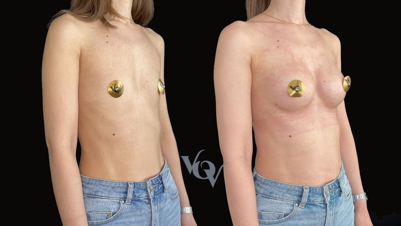 Замена имплантов. 3 месяца после операции