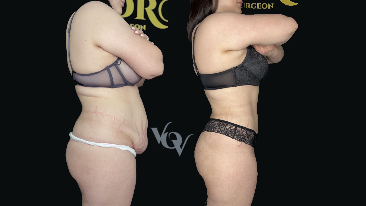 Абдоминопластика. 3 месяца после операции