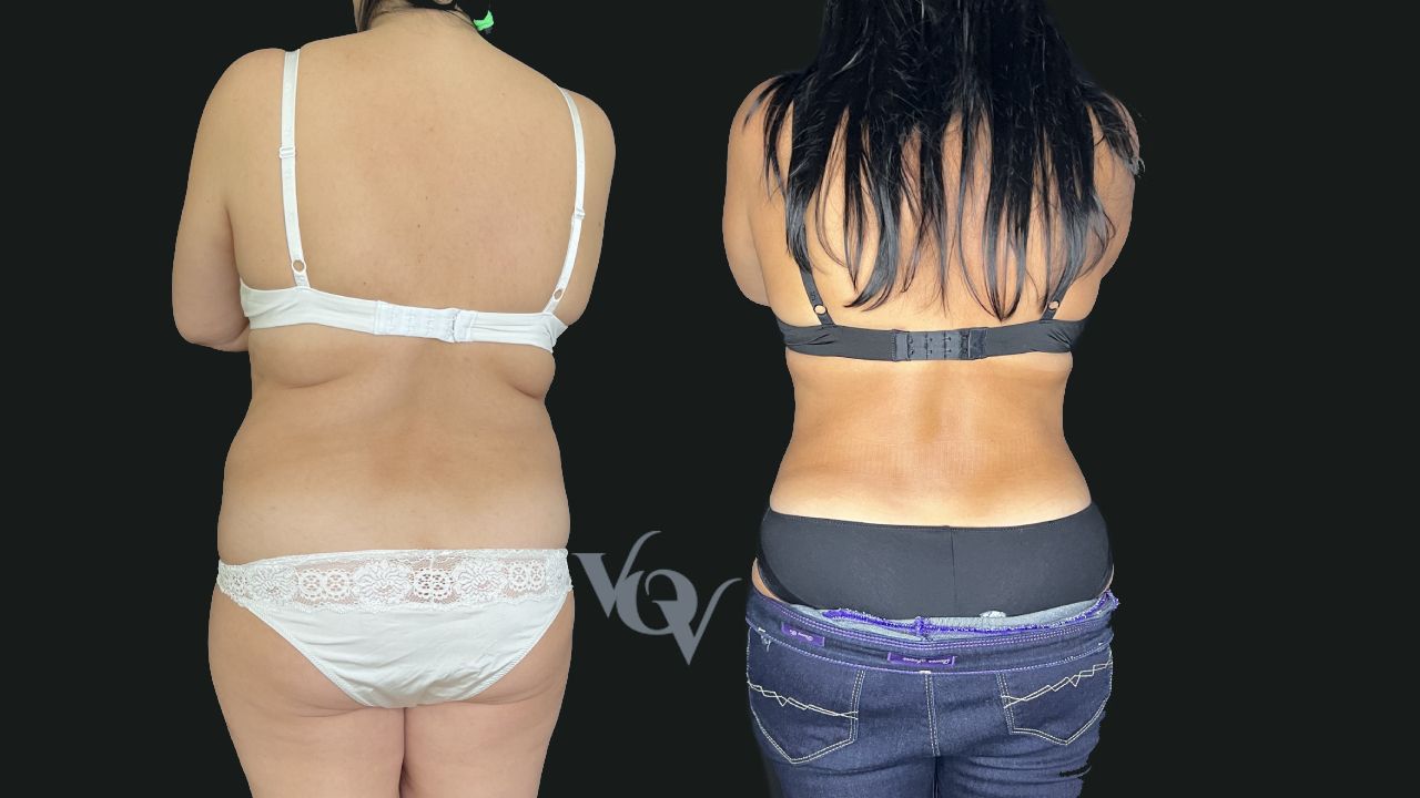 Липосакция спины. 6 месяцев после операции