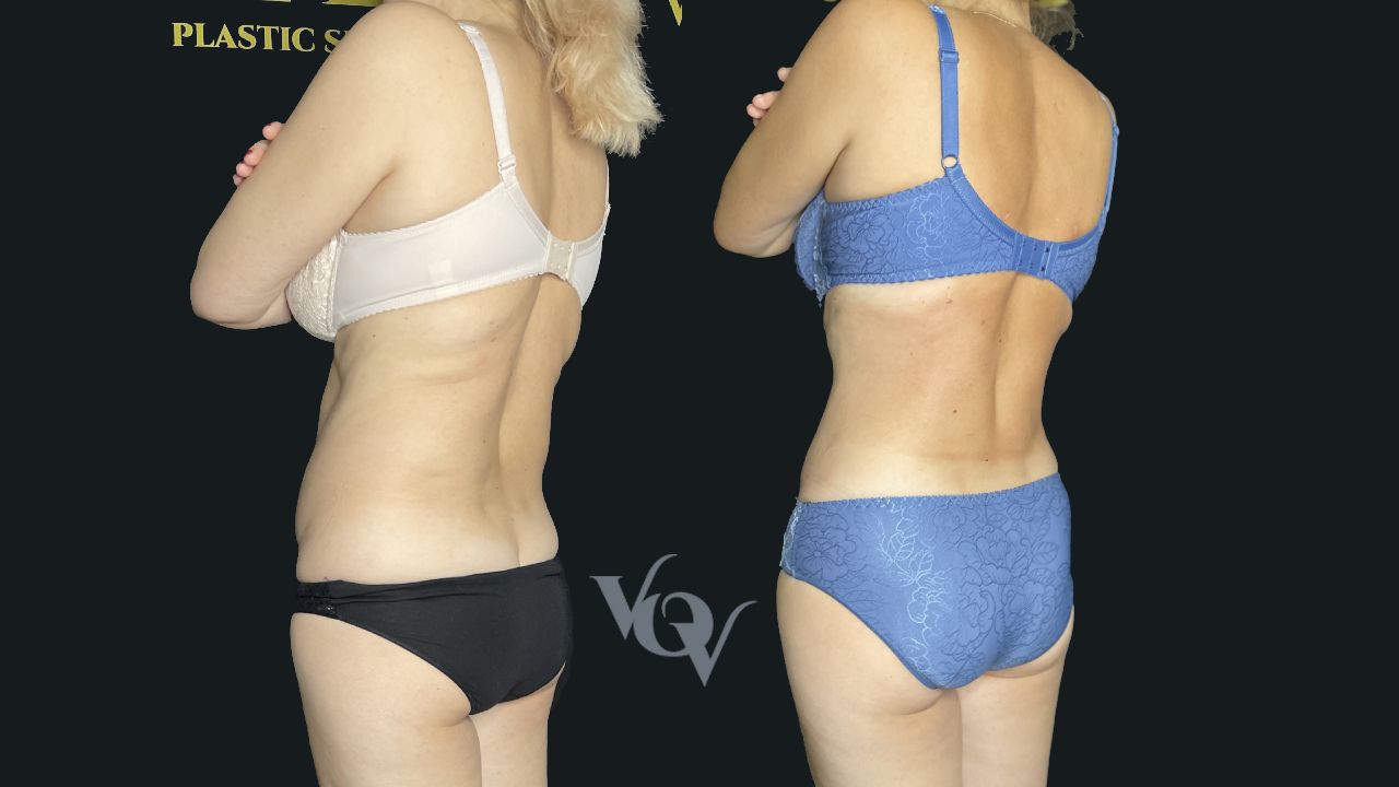 Липосакция спины. 4 месяца после операции