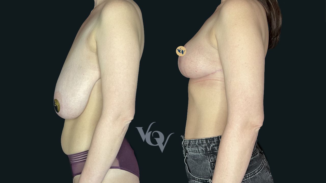 Уменьшение груди. 2 месяца после операции 