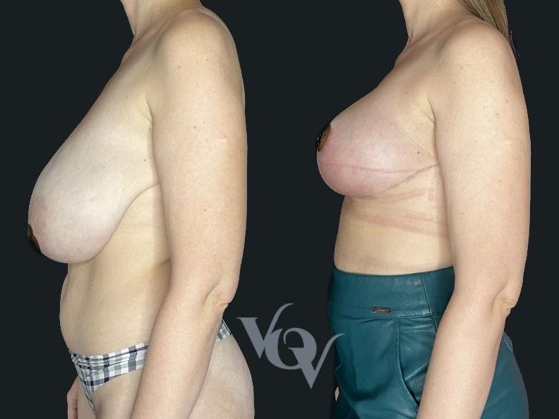 Якорная подтяжка груди. 2 месяца после операции