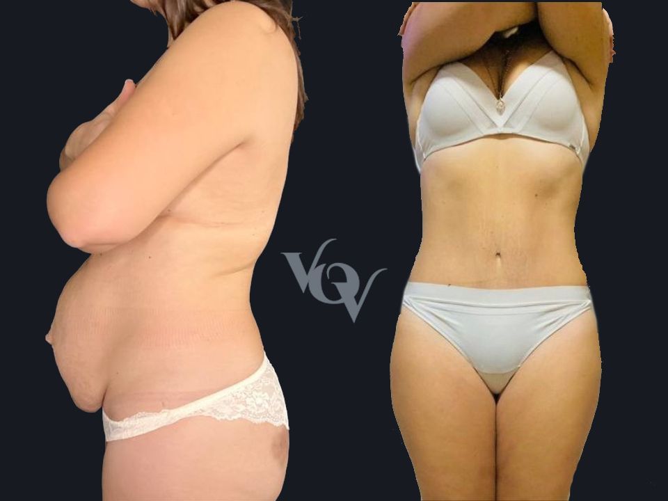 Абдоминопластика. 1 год после операции