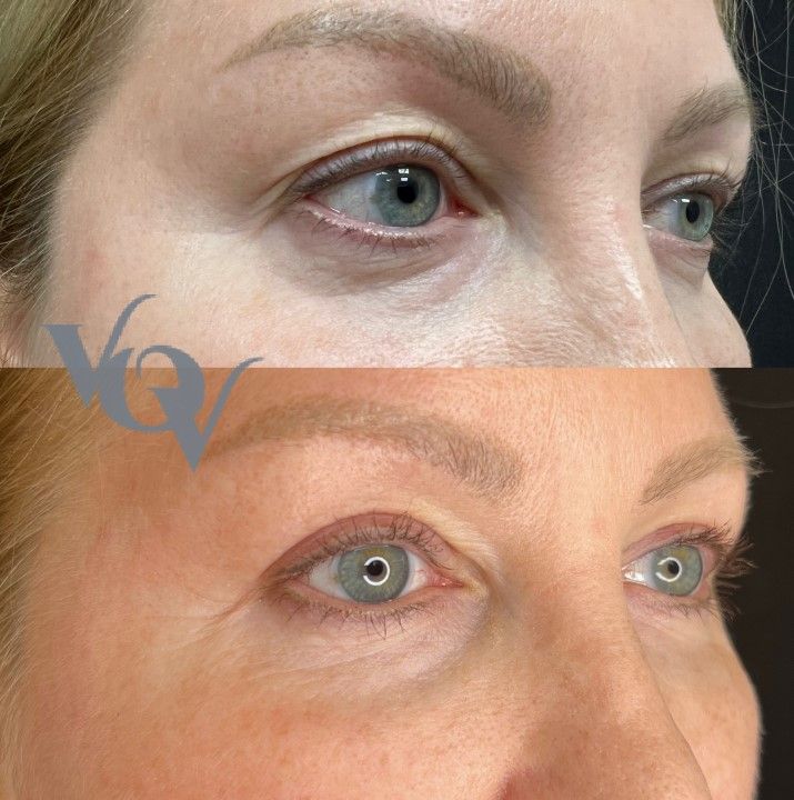 Верхняя блефаропластика. 1.5 месяца после операции