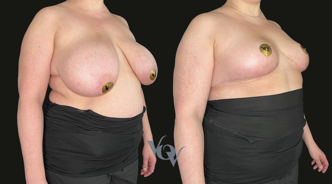 Уменьшение груди. 3 месяца после операции 