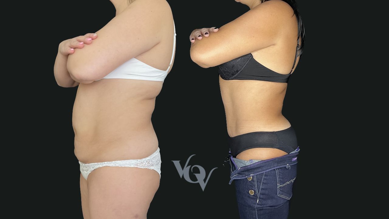 Абдоминопластика. 6 месяцев после операции