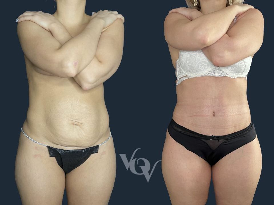 Абдоминопластика. 1 месяц после операции