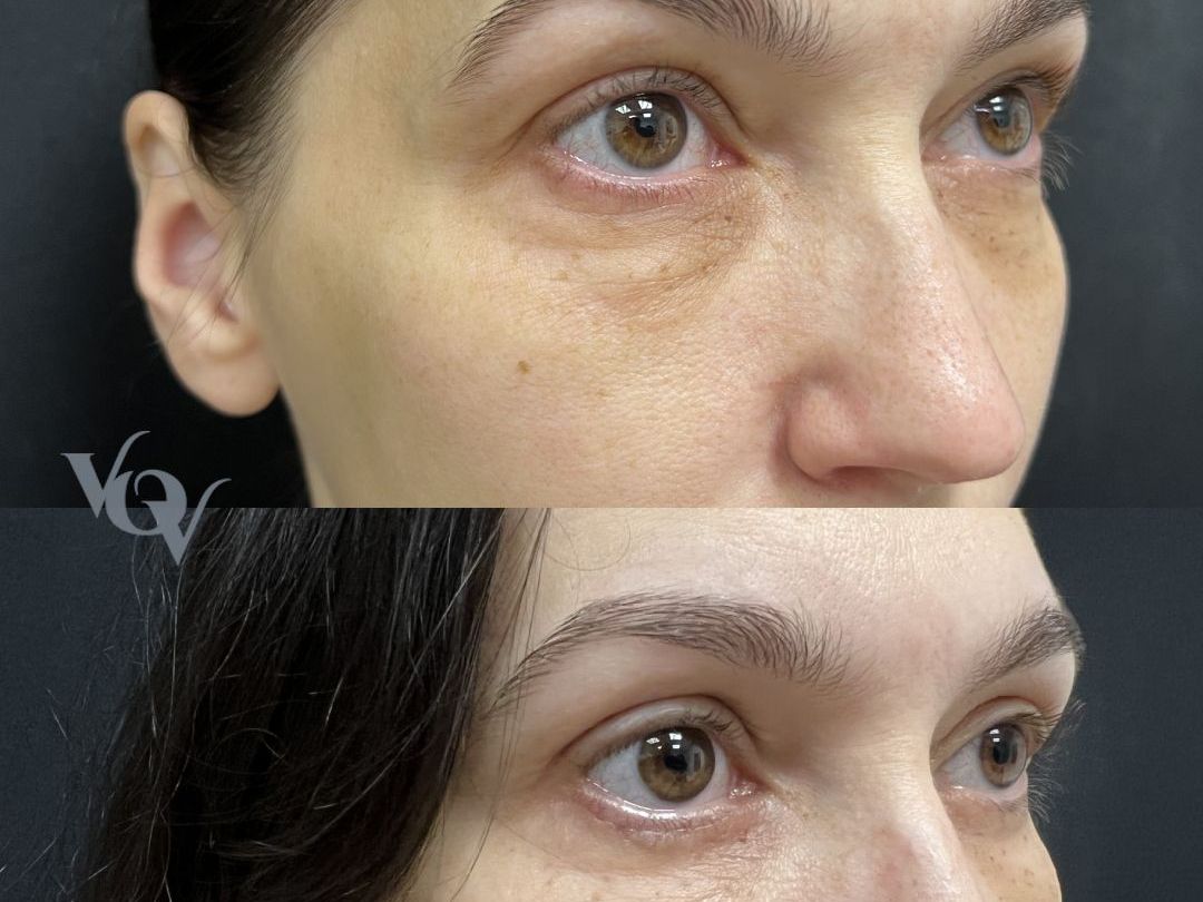 Круговая блефаропластика. 1 месяц после операции