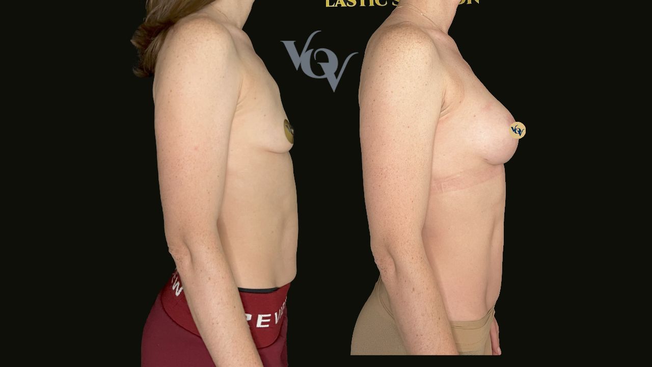 Замена имплантов. 2,5 месяца после операции