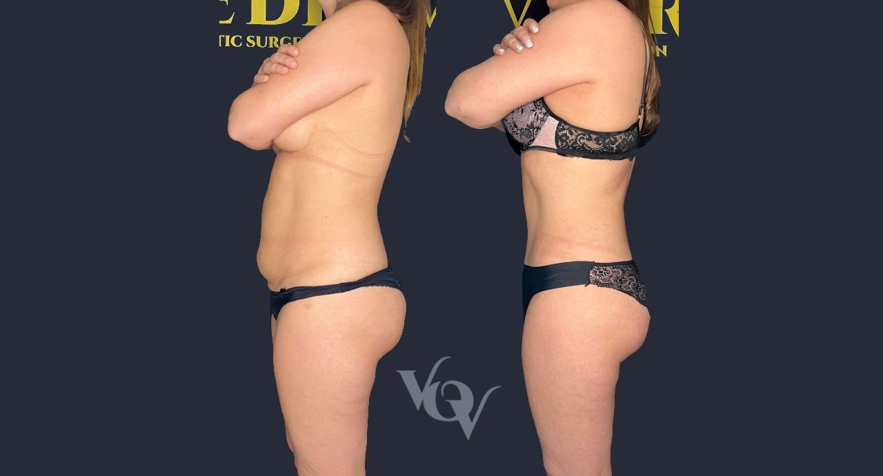 Абдоминопластика. 6 месяцев после операции