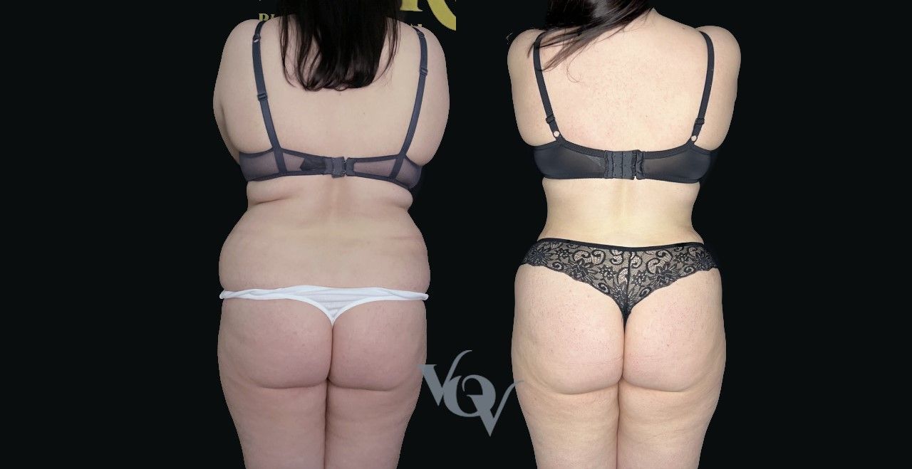 Липосакция спины. 3 месяца после операции