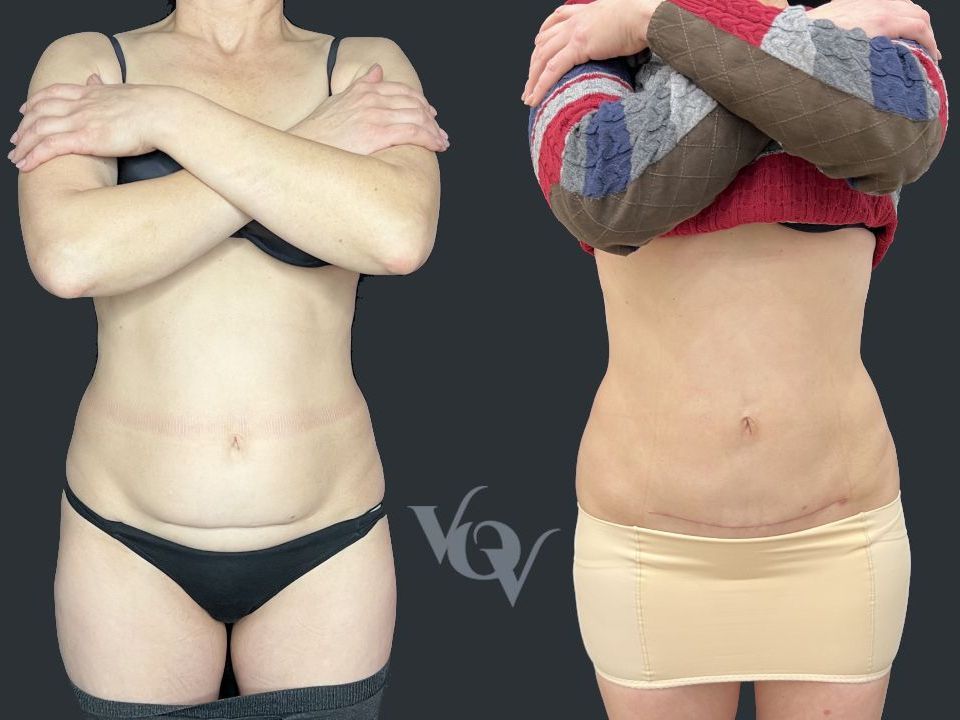 Миниабдоминопластика. 3 месяца после операции