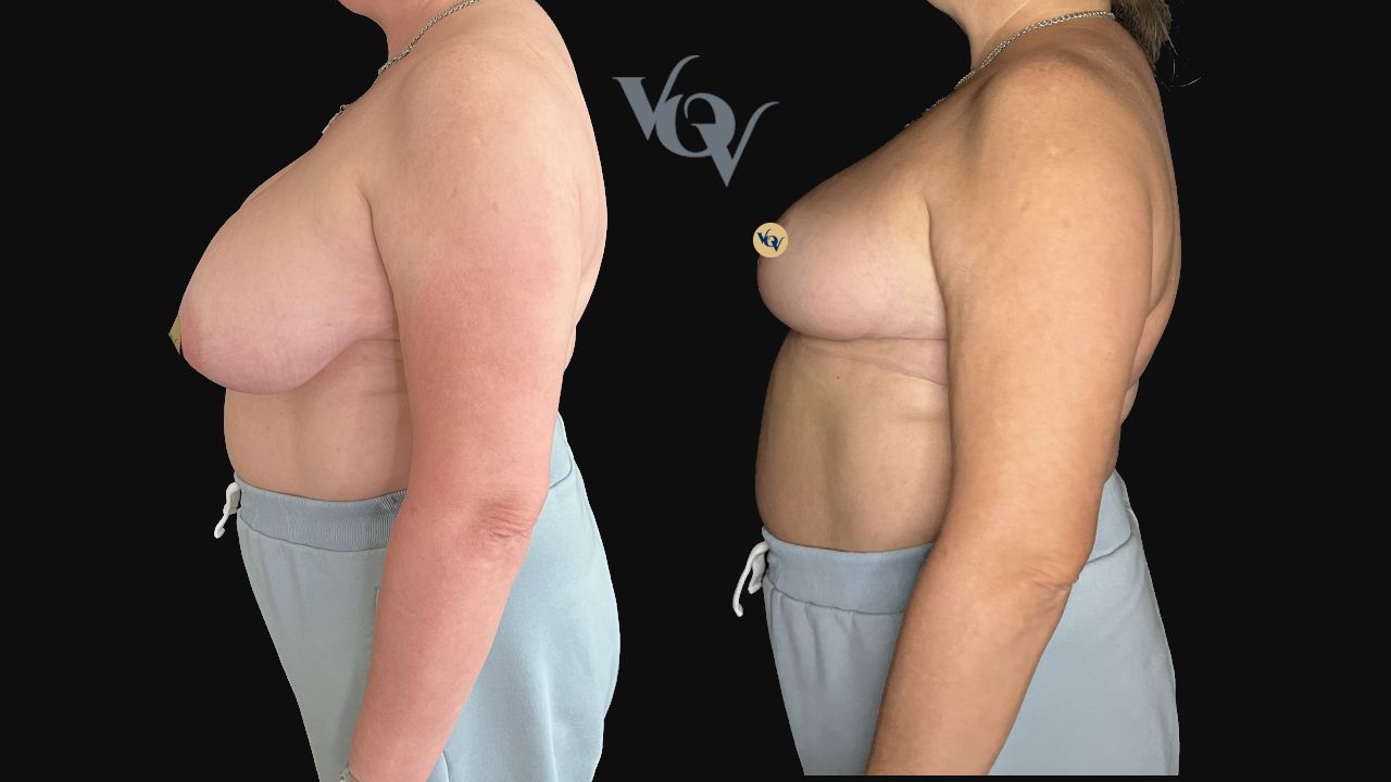 Уменьшение груди. 3 месяца после операции 