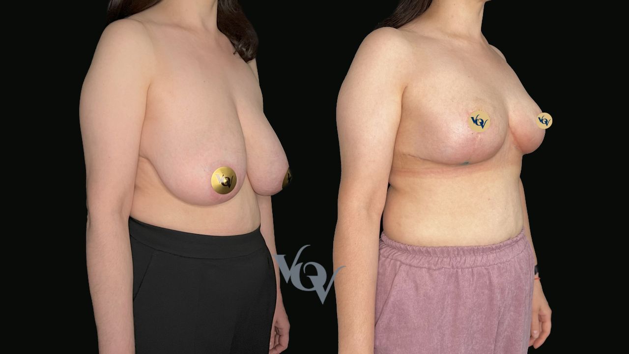 Уменьшение груди. 2 месяца после операции 