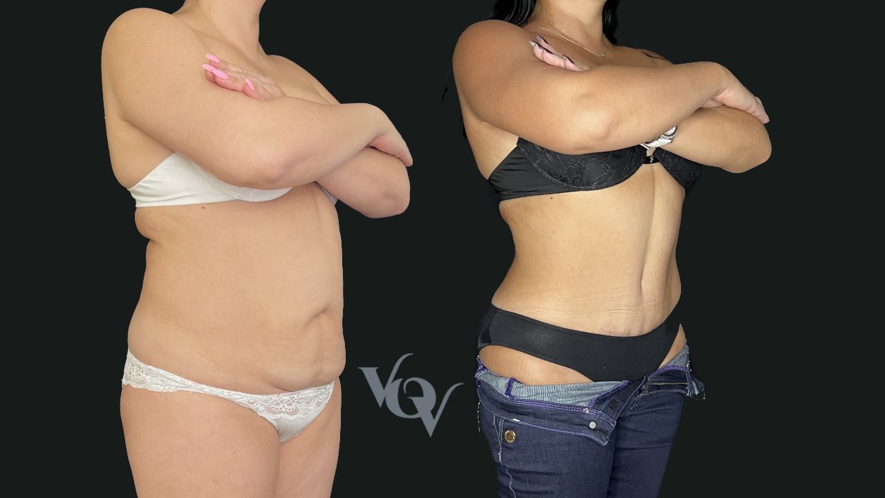 Абдоминопластика. 6 месяцев после операции