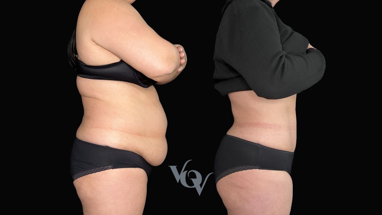 Абдоминопластика. 6 месяцев после операции