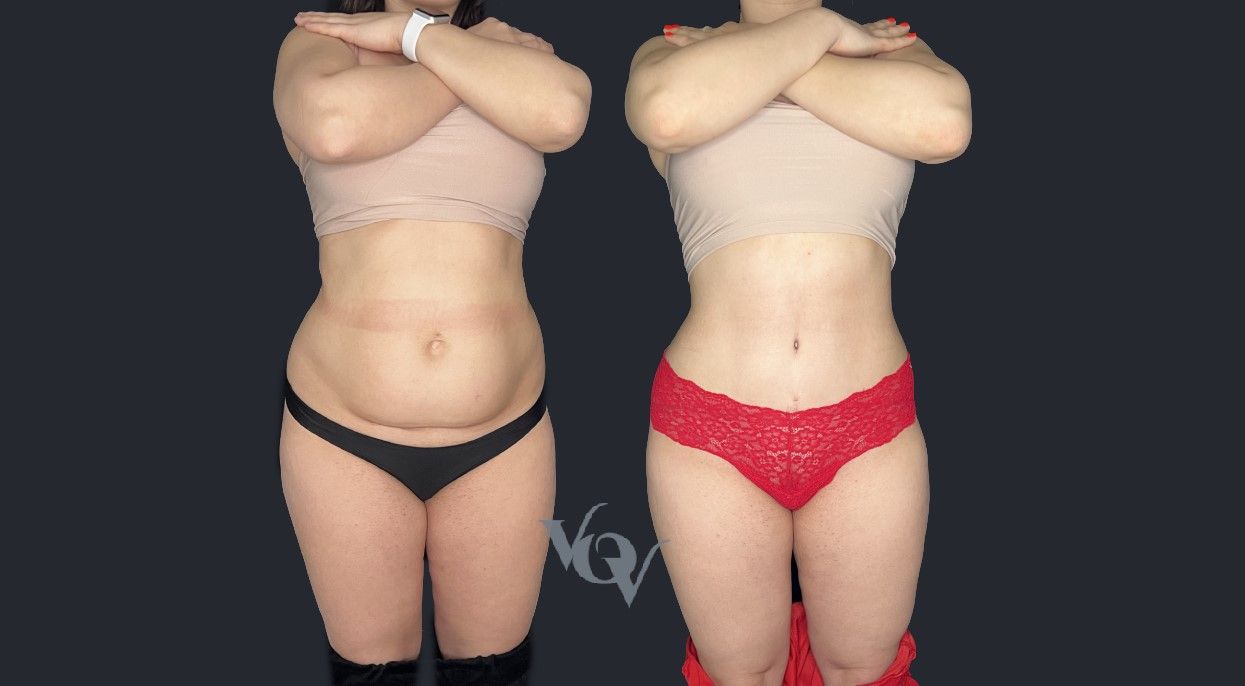 Абдоминопластика. 2.5 месяца после операции