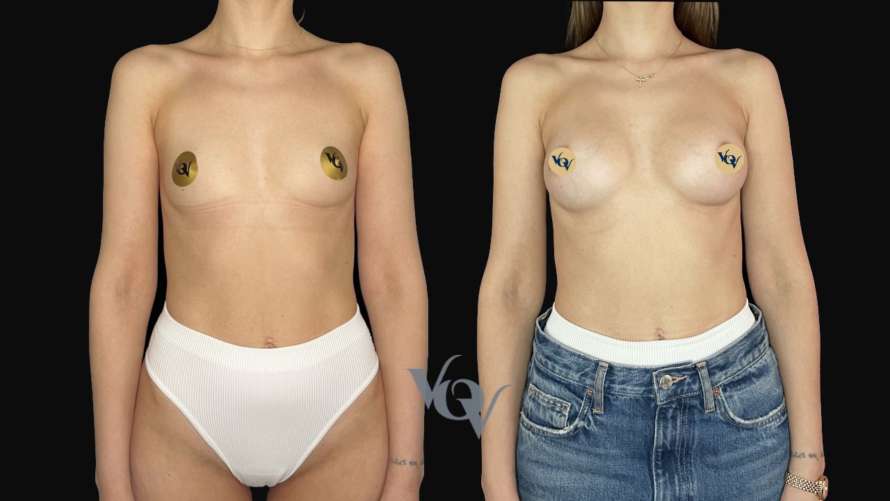 Замена имплантов. 1 год после операции