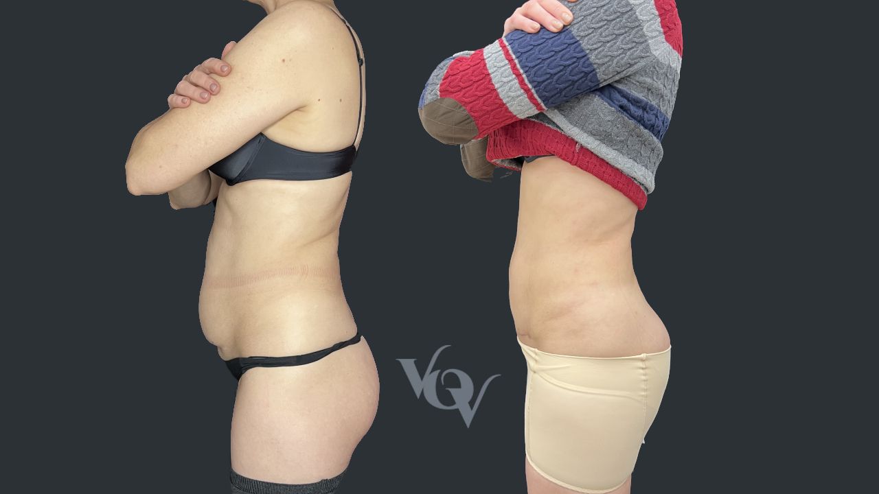 Миниабдоминопластика. 3 месяца после операции