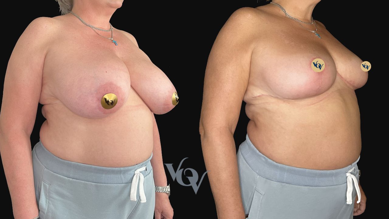 Уменьшение груди. 3 месяца после операции 