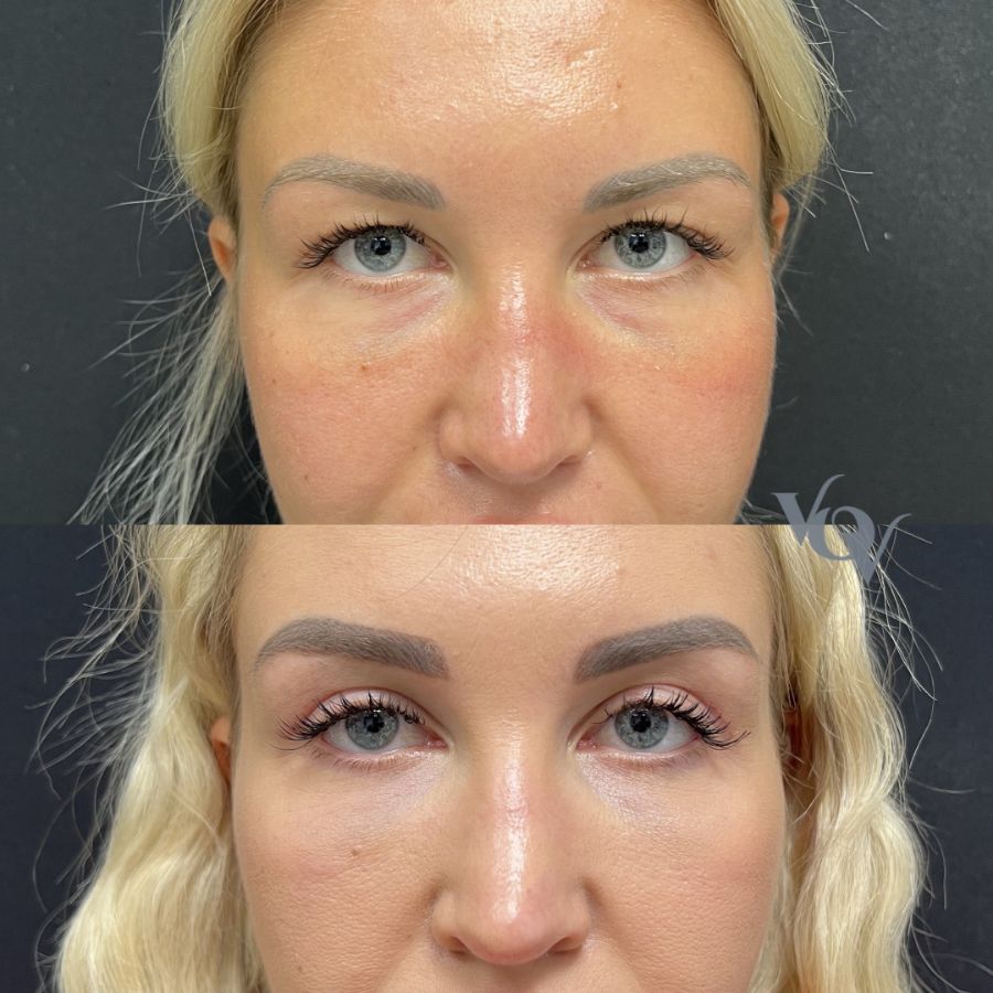 Верхняя блефаропластика. 1 месяц после операции