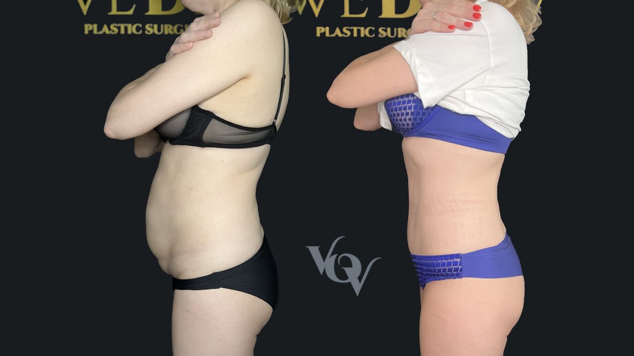 Абдоминопластика. 3 месяца после операции