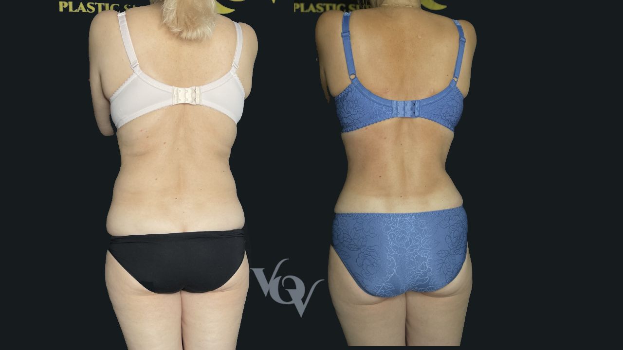 Липосакция спины. 4 месяца после операции