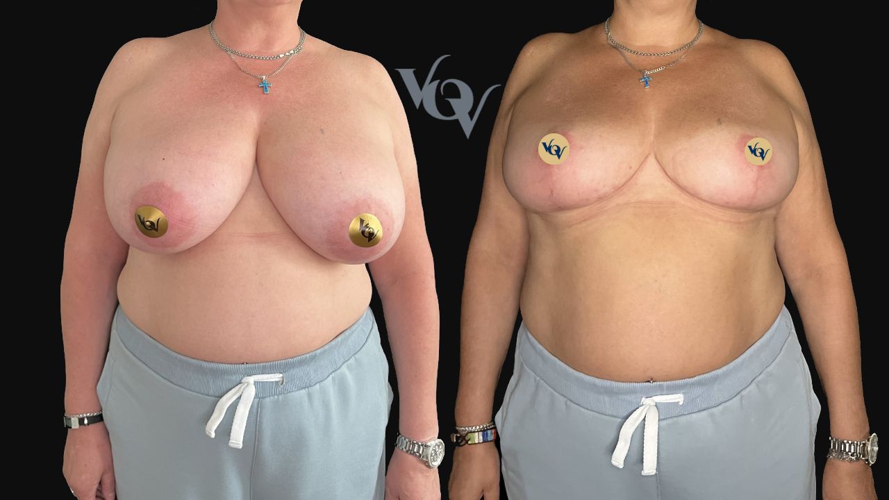 Уменьшение груди. 3 месяца после операции 