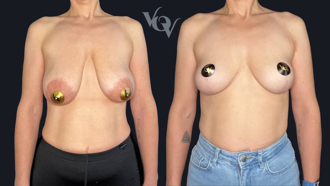 Подтяжка груди. 3 месяца после операции