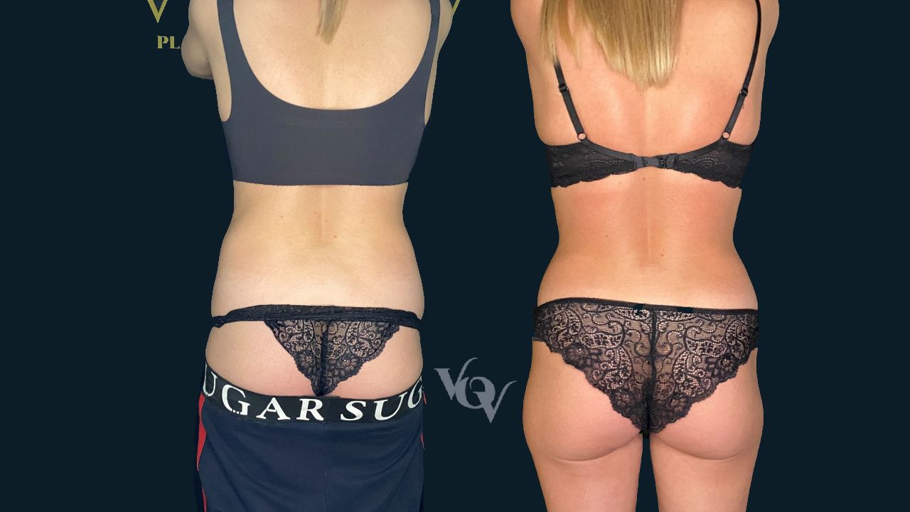 Липосакция спины. 2 месяца после операции