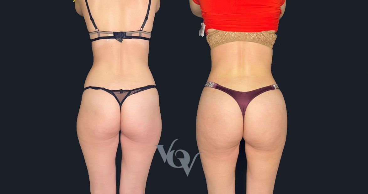 Липофилинг ягодиц. 4 месяца после операции