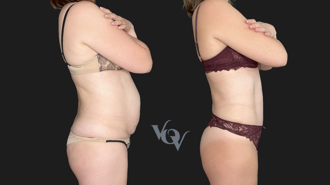 Абдоминопластика. 4 месяца после операции