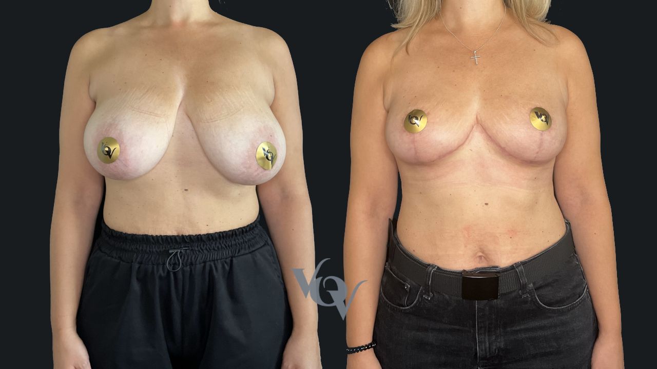 Подтяжка груди. 1 месяц после операции