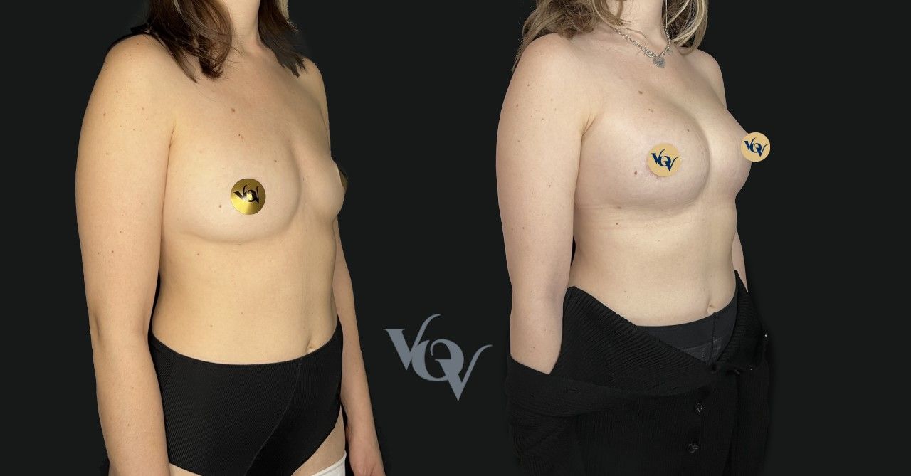 Замена имплантов. 1 месяц после операции