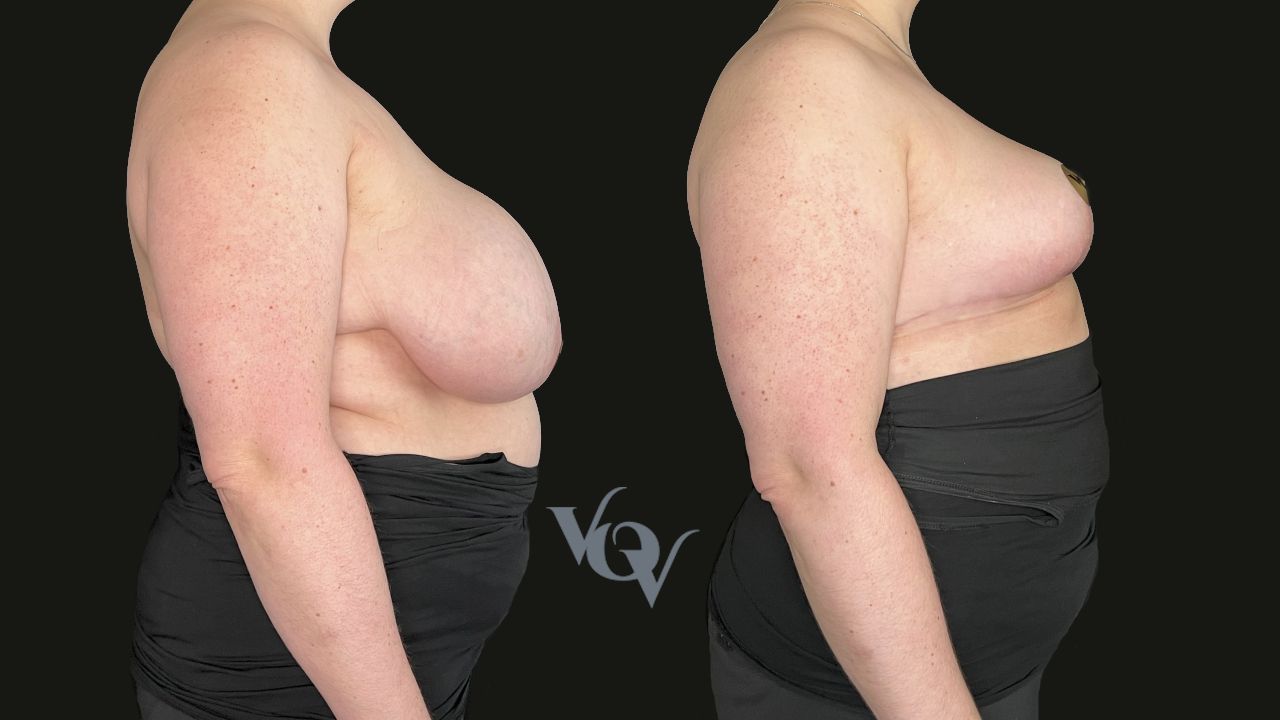 Уменьшение груди. 2 месяца после операции 