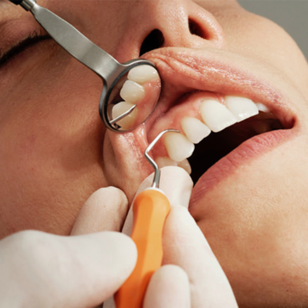 Лечение кариеса в стоматологической клинике Olio.kg.  Пломбирование зубов качественными материалами - Olio.kg ОЛИО