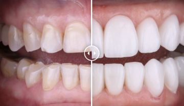 Лечение зубов