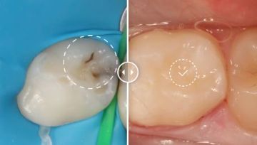 Лечение зубов