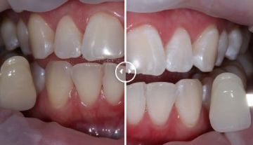 Лечение зубов