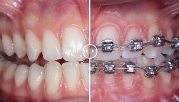 Лечение зубов