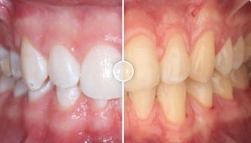 Лечение зубов