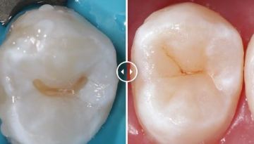 Лечение зубов